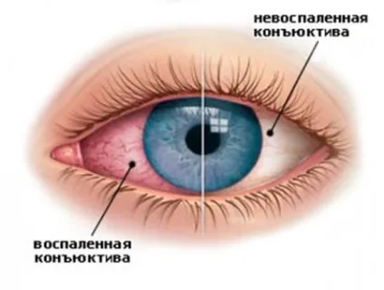 Почервоніння слизової очі (гіперемія кон'юнктиви) (також) Почервоніння слизової очі (гіперемія кон'юнктиви)