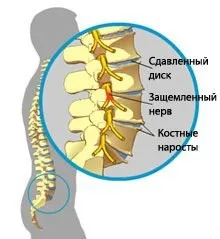 Після сну болить спина найбільш часті причини (спина) Після сну болить спина найбільш часті причини