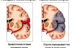 Наслідки великого інсульту