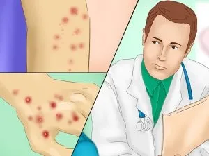 Пітниця у дорослих в паху, на ногах - як позбутися і швидко прибрати причини і лікування (дорослих) Пітниця у дорослих в паху, на ногах - як позбутися і швидко прибрати причини і лікування