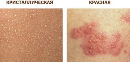 Пітниця на ногах у дорослих симптоми і лікування потнички між ніг і на стопах (лікування) Пітниця на ногах у дорослих симптоми і лікування потнички між ніг і на стопах