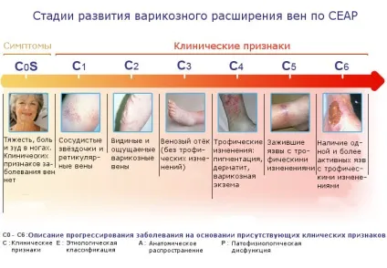 Посттромбофлебітичний синдром причини, симптоми і лікування