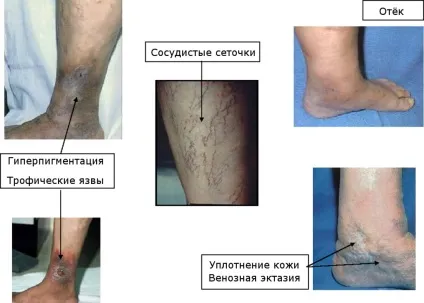 Посттромбофлебітичний синдром причини, симптоми і лікування