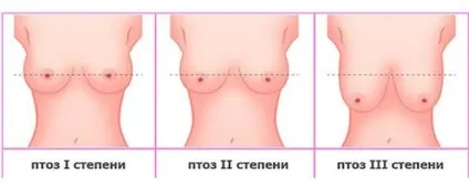 Причини появи птозу грудей, його стадії та виду лікування (причини) Причини появи птозу грудей, його стадії та виду лікування