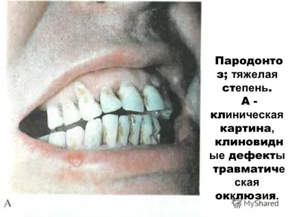Презентація на тему пародонтоз і пародонтит (пародонтоз) Презентація на тему пародонтоз і пародонтит