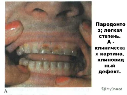 Презентація на тему пародонтоз і пародонтит (еский генерал зован) Презентація на тему пародонтоз і пародонтит