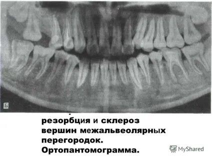 Презентація на тему пародонтоз і пародонтит (тему) Презентація на тему пародонтоз і пародонтит