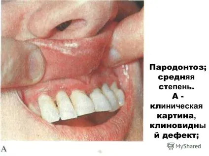 Презентація на тему пародонтоз і пародонтит (пародонтоз і пародонтит. Клініка. Методи дослідження) Презентація на тему пародонтоз і пародонтит