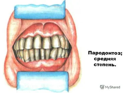 Презентація на тему пародонтоз і пародонтит (Хрон еский генерал) Презентація на тему пародонтоз і пародонтит