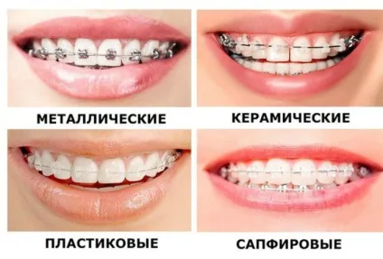 Принципи дії брекет-систем для зубів
