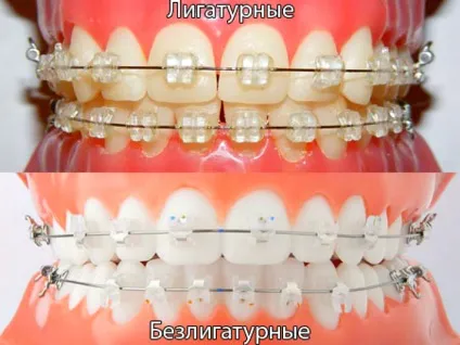 Принципи дії брекет-систем для зубів