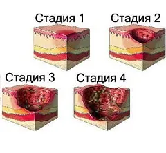 Пролежні - причини, ступеня, місця освіти, лікування, профілактика (пролежні профілактика) Пролежні - причини, ступеня, місця освіти, лікування, профілактика