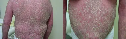 Псоріаз і алкоголь