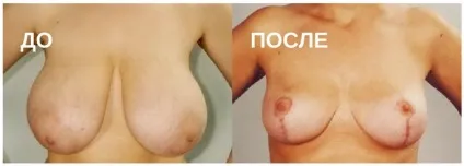 Птоз грудей проблема і методи вирішення