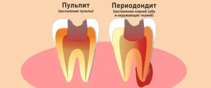 Пульпіт зуба - що це таке і як його лікувати