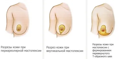 Птоз грудей проблема і методи вирішення
