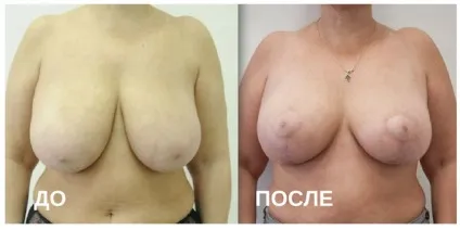 Птоз грудей проблема і методи вирішення