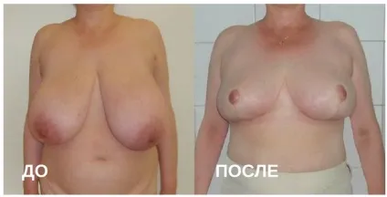 Птоз грудей проблема і методи вирішення