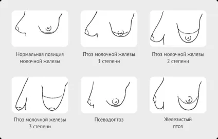 Птоз грудей проблема і методи вирішення
