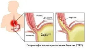 Рефлюкс лікування медикаменти, народні засоби (рефлюкс) Рефлюкс лікування медикаменти, народні засоби