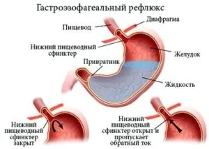 Рефлюкс лікування медикаменти, народні засоби (лікування) Рефлюкс лікування медикаменти, народні засоби