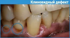 Реставрація зубів фотополімерами 1 (зубів) Реставрація зубів фотополімерами 1