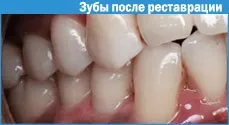 Реставрація зубів фотополімерами 1 (фотополімерні пломби) Реставрація зубів фотополімерами 1