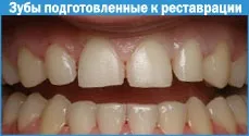 Реставрація зубів фотополімерами 1 (оточуючих Фотополімерні пломби) Реставрація зубів фотополімерами 1