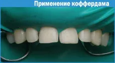 Реставрація зубів фотополімерами 1 (фотополімерні матеріали) Реставрація зубів фотополімерами 1