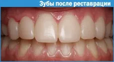 Реставрація зубів фотополімерами 1 (оточуючих Фотополімерні пломби) Реставрація зубів фотополімерами 1