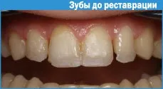Реставрація зубів фотополімерами 1 (реставрація зубів фотополімерами) Реставрація зубів фотополімерами 1