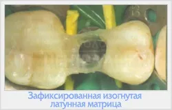 Реставрація зубів фотополімерами 1 (зубів) Реставрація зубів фотополімерами 1