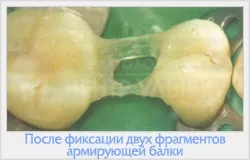 Реставрація зубів фотополімерами 1 (реставрація зубів фотополімерами) Реставрація зубів фотополімерами 1