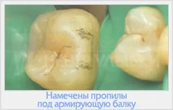 Реставрація зубів фотополімерами 1 (фотополімерні матеріали) Реставрація зубів фотополімерами 1