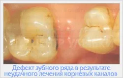 Реставрація зубів фотополімерами 1 (фотополімерні матеріали) Реставрація зубів фотополімерами 1