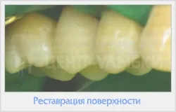 Реставрація зубів фотополімерами 1 (фотополімерні матеріали) Реставрація зубів фотополімерами 1