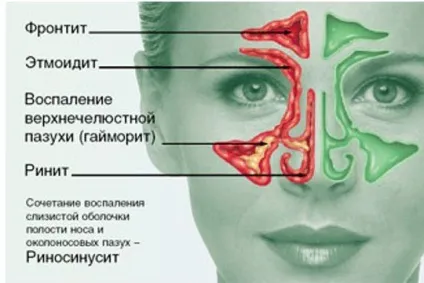 Риносинусит що це, симптоми алергічного риносинусита і медикаментозне лікування (риносинусит що це алергічний симптоми лікування) Риносинусит що це, симптоми алергічного риносинусита і медикаментозне лікування