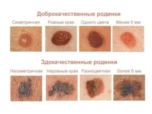 Родимка на скроні її значення і чи небезпечна (родимка) Родимка на скроні її значення і чи небезпечна