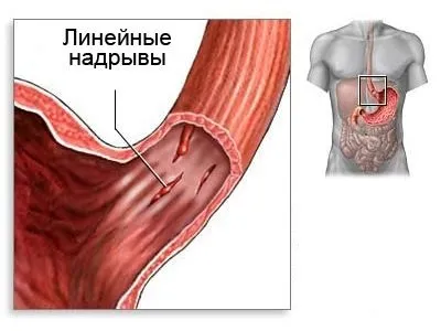 Блювота з кров'ю після алкоголю причини, що робити (після) Блювота з кров'ю після алкоголю причини, що робити