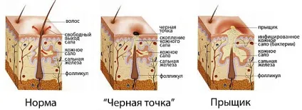 Сальні залози закупорка, запалення і порушення роботи (закупорка) Сальні залози закупорка, запалення і порушення роботи
