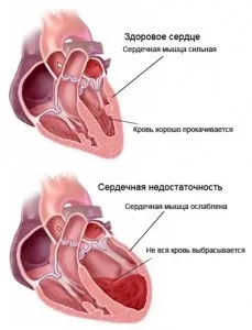 Серцева недостатність - симптоми і лікування народними засобами глід, дробове харчування, (симптоми) Серцева недостатність - симптоми і лікування народними засобами глід, дробове харчування,