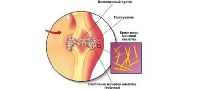 Шишка на мізинці ноги причини і лікування (лікування) Шишка на мізинці ноги причини і лікування