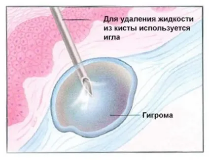 Шишка на мізинці ноги причини і лікування (лікування) Шишка на мізинці ноги причини і лікування