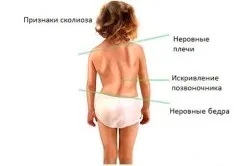 Лівобічний сколіоз хребта (допомога хребту) Лівобічний сколіоз хребта
