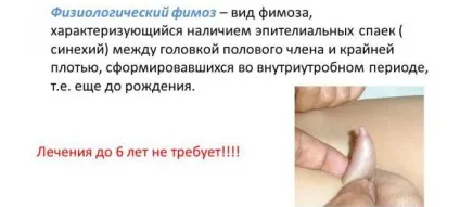Лікування тріщин на крайньої плоті у чоловіків