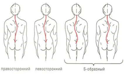 Лівобічний сколіоз хребта (зміни дисках хребцях) Лівобічний сколіоз хребта