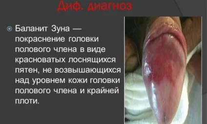 Лікування тріщин на крайньої плоті у чоловіків