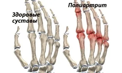 Лікування поліартриту пальців рук народними засобами (пальців) Лікування поліартриту пальців рук народними засобами