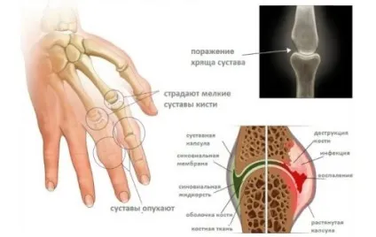 Лікування поліартриту пальців рук народними засобами (пальців) Лікування поліартриту пальців рук народними засобами