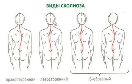 Лівобічний сколіоз хребта у дітей та дорослих (грудного хребця лівобічний) Лівобічний сколіоз хребта у дітей та дорослих